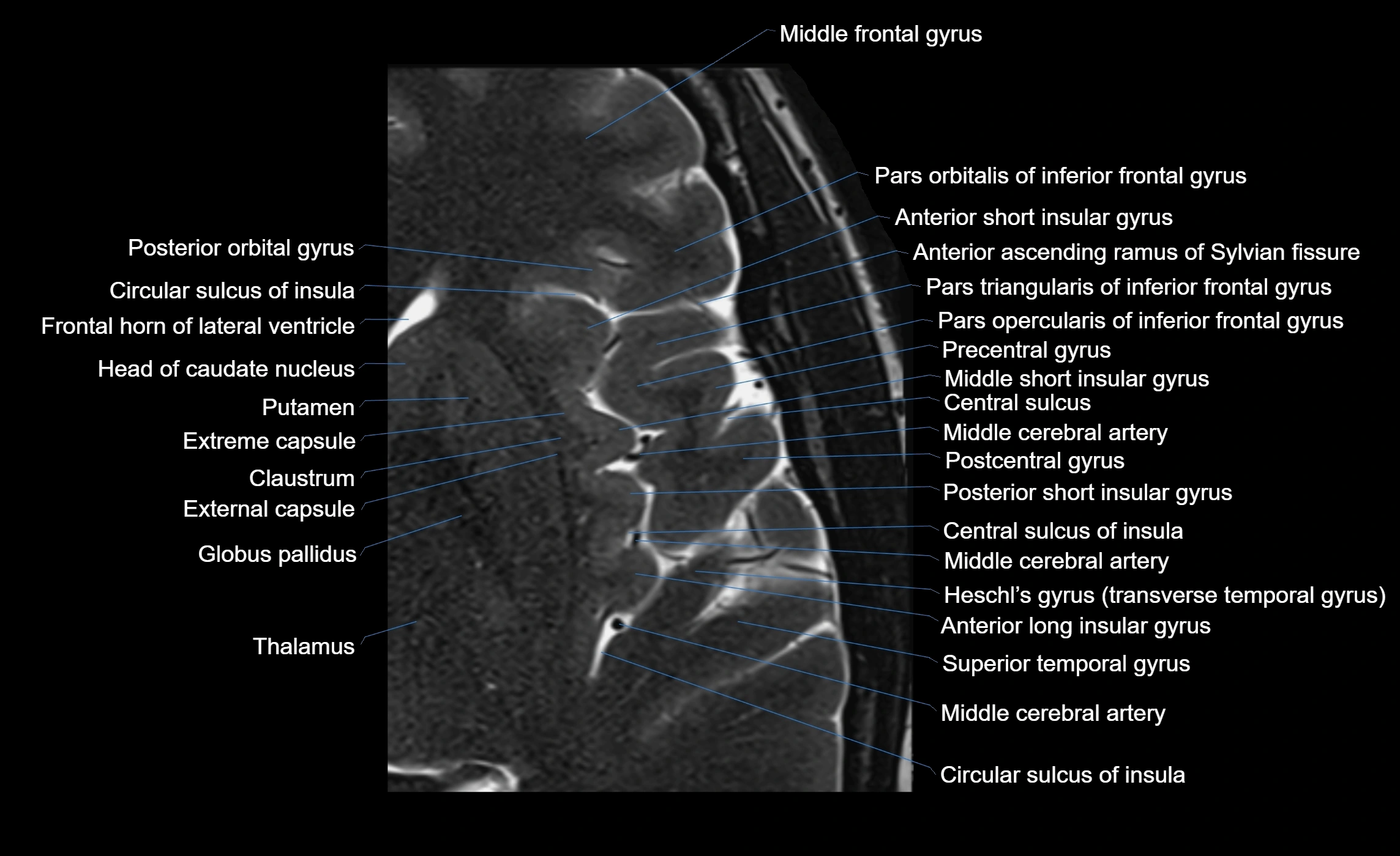 Brain insula axial  anatomy 3T MRI image-img-00001-00011.webp